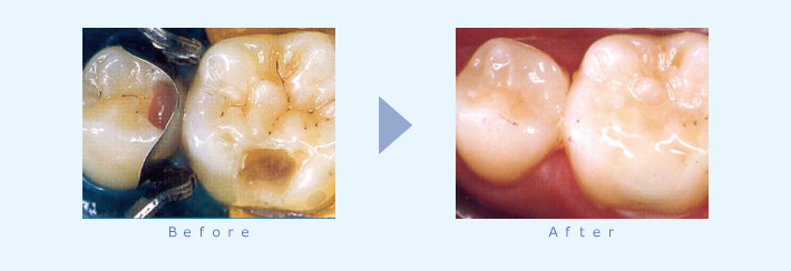 歯の詰め物のビフォアーアフターの写真